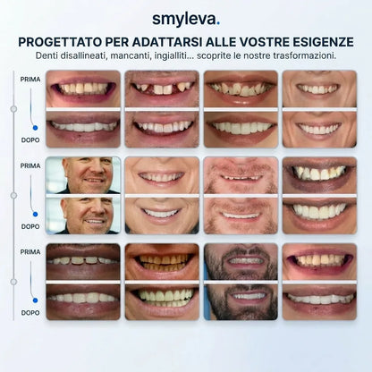 Faccette Adattabili e Rimovibili